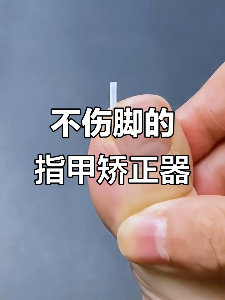 指甲长肉里?试试这个小工具,轻松矫正不伤脚
