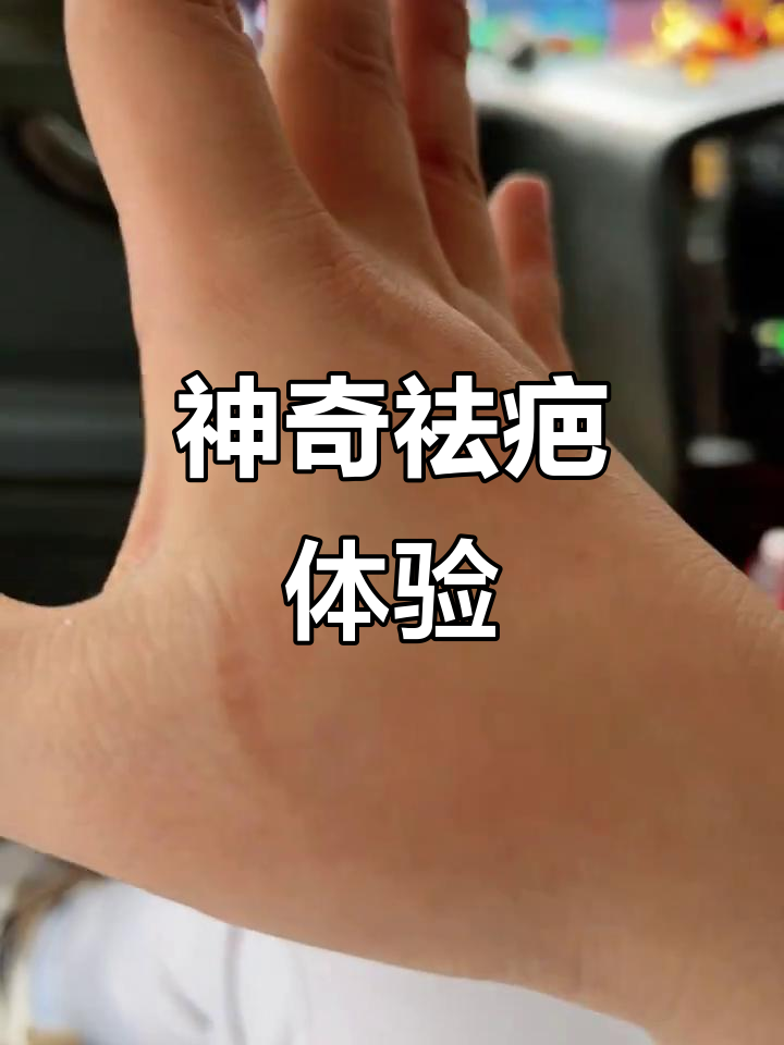 新加坡鳄鱼油效果显著，手部干裂消失，期待疤痕淡化！