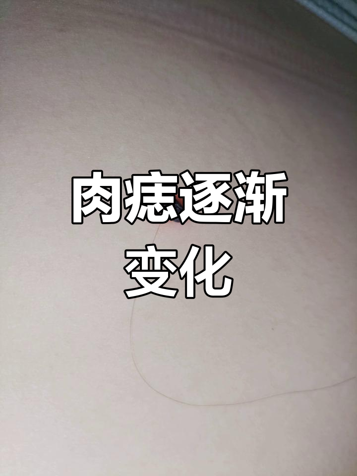 肉痣变黑干硬,水泡消失后留下痕迹