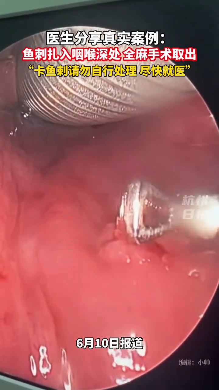 医生分享案例:鱼刺卡喉,全麻取出……请勿自行处理!