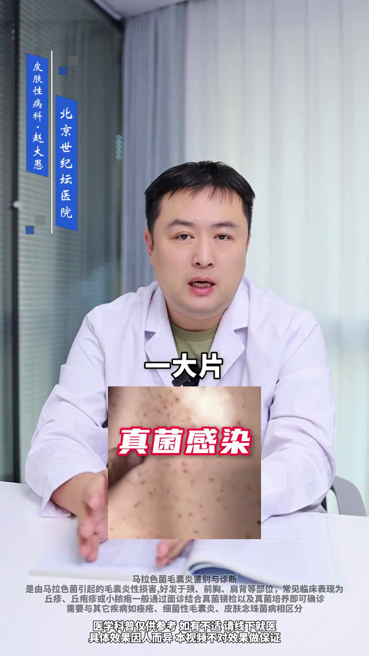 皮肤性病科医生赵大愚:前胸后背长小红疙瘩怎么办?