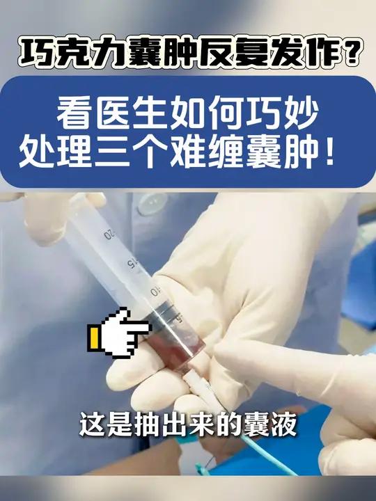 多发巧囊手术实录 巧克力囊肿 硬核健康科普行动 超声介入董刚医生 女性健康
