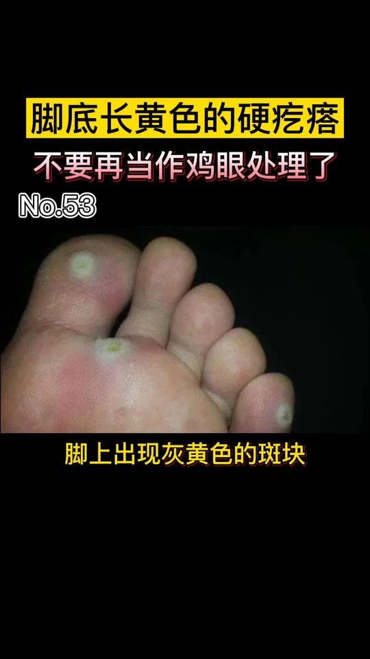 很多人把跖疣和鸡眼弄混,错过了一开始的处理时机