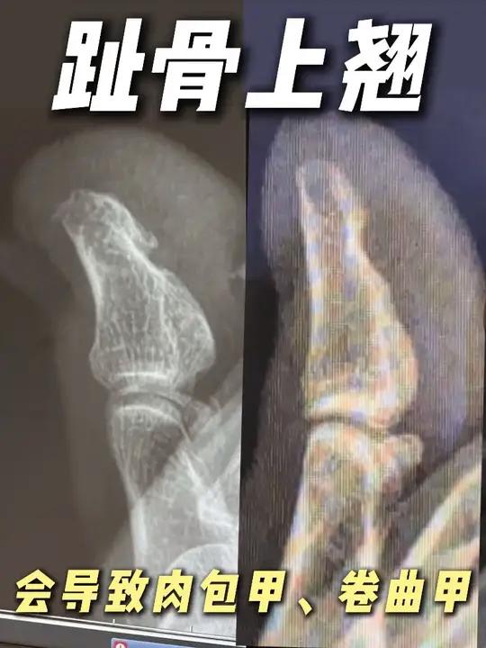 肉包甲|卷曲甲|末端趾骨上翘 
