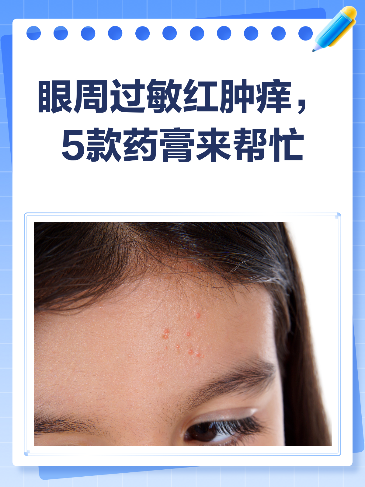 眼周过敏红肿痒?这些药膏来帮忙