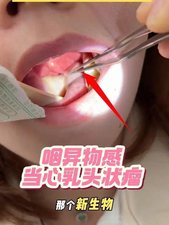 喉咙有异物感,小心乳头状瘤 喉咙有异物感、咳不出咽不下?小心不是梅核气,而是长了乳头状瘤#