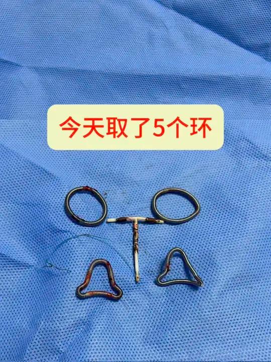 今天取了5个环 建议绝经后女性及时取环