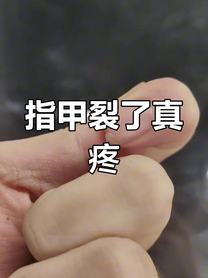 手指甲裂开,痛到不行