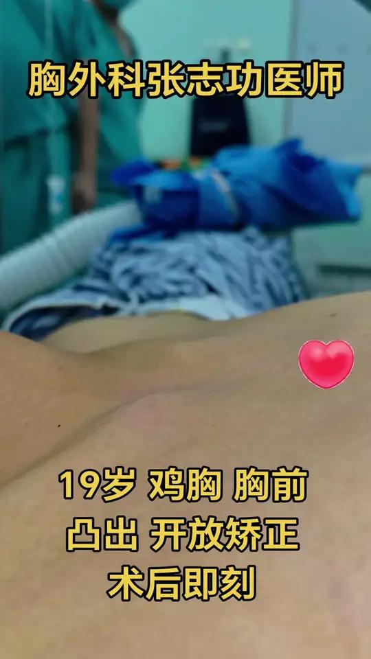 19岁 不对称 鸡胸,胸前凸出,开放矫正术,术后即刻外观 19岁 不对称 鸡胸胸前凸出开放
