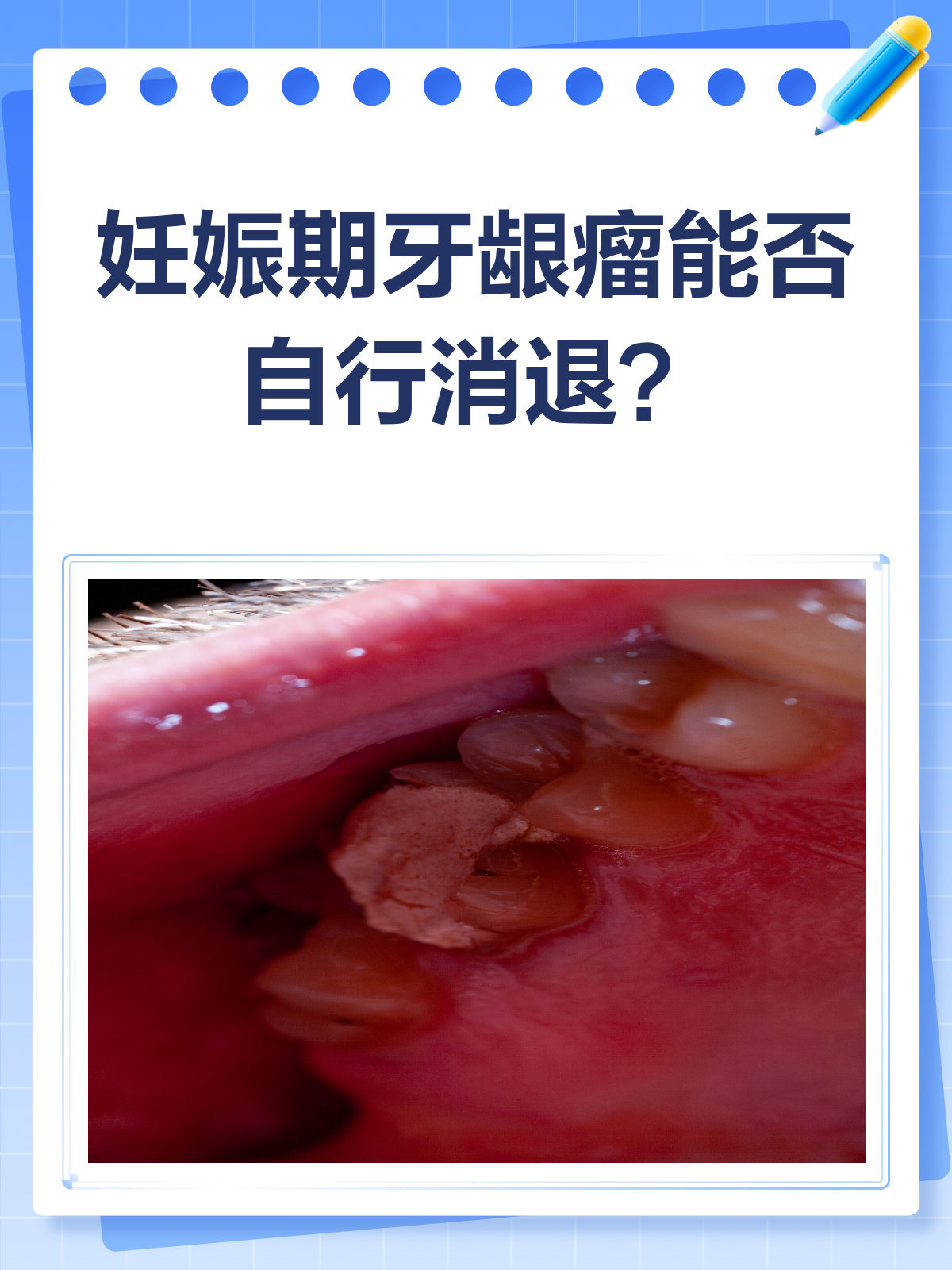 妊娠期牙龈长“肉坨”?别急,它可能会自己消失!