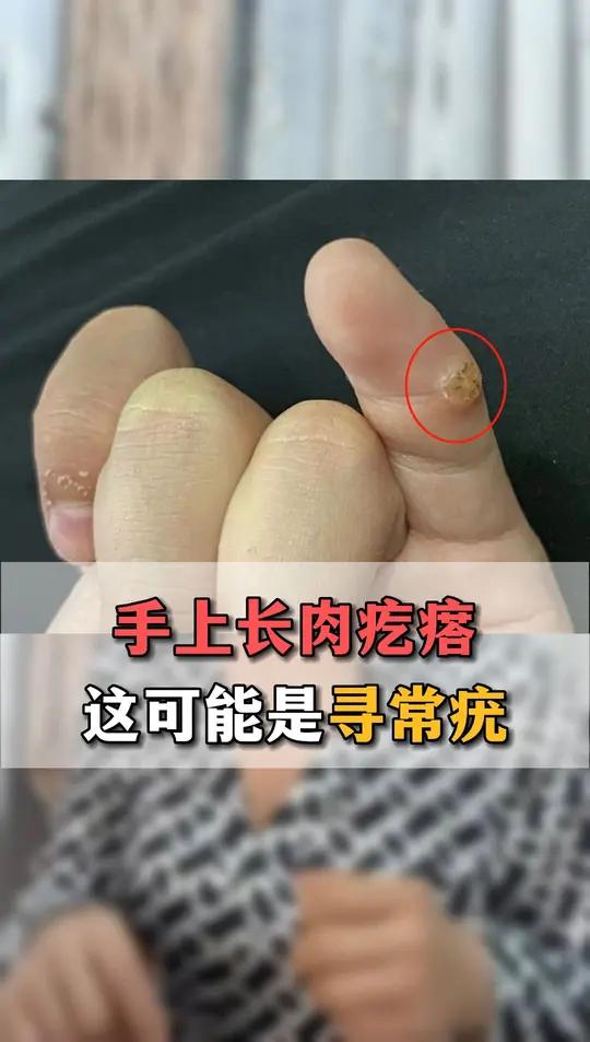 手上长肉疙瘩这可能是寻常疣