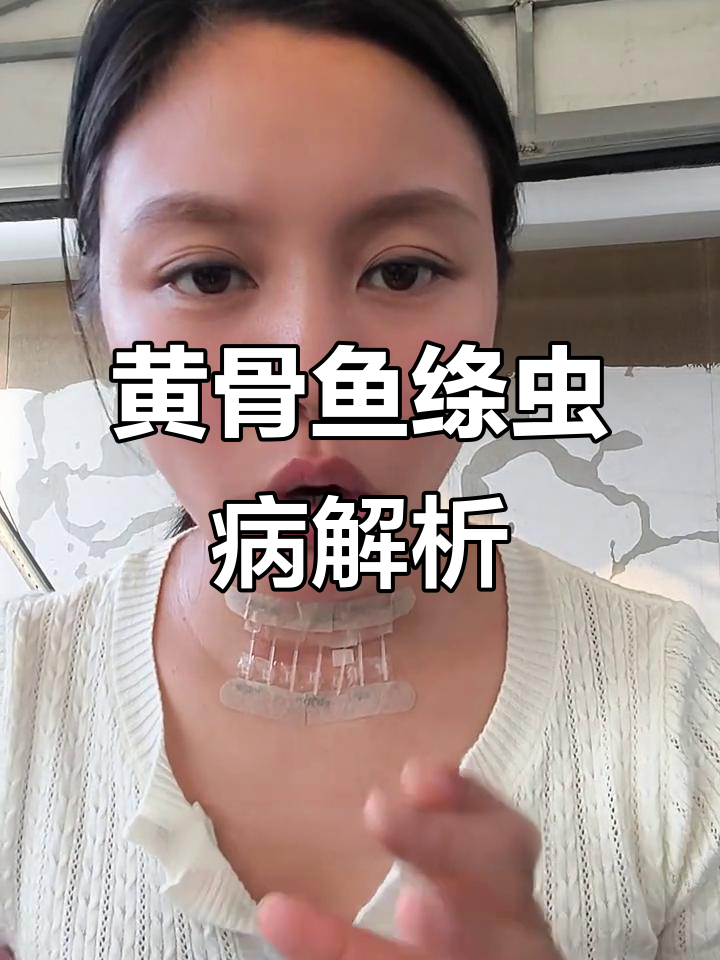 黄骨鱼绦虫感染:如何判断与防治