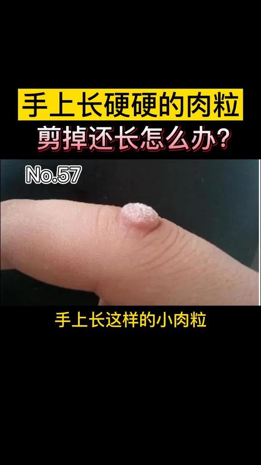 手上长硬硬的肉粒,剪掉还会长,这是寻常疣,可以这么办