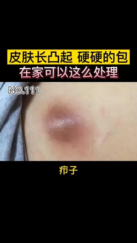 皮肤上长凸起、硬硬的包,火疖子千万不要挤,可以这么办