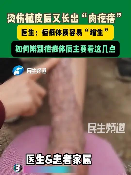 烫伤植皮后又长出“肉疙瘩”。医生：疤痕体质容易“增生”。如何辨别疤痕体质主要看这几点
