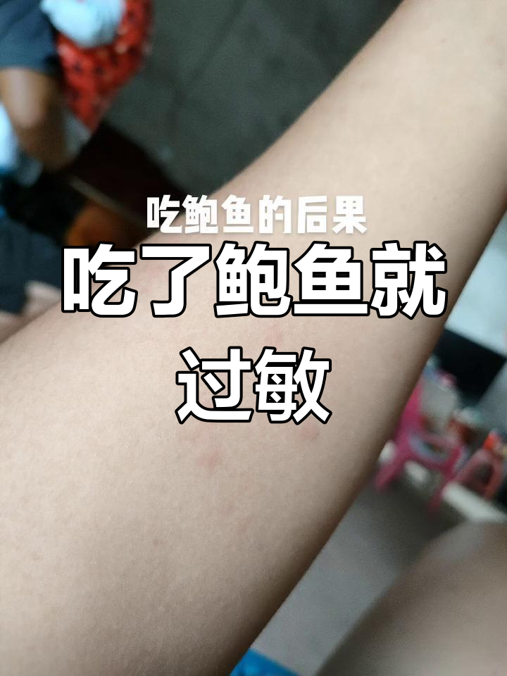 吃鲍鱼引发过敏,两天打针吃药