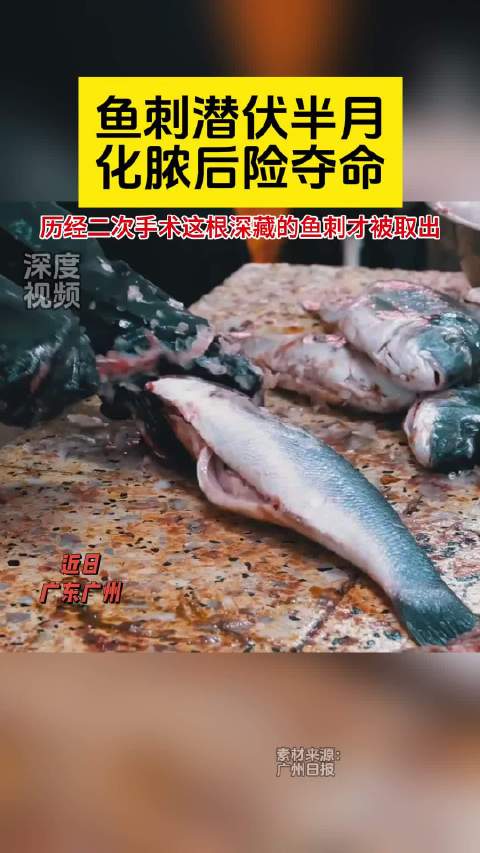 「鱼刺潜伏半月化脓后险夺命」半个多月前,广东居民王先生(化名)吃鱼时不小心被一根长约1.5