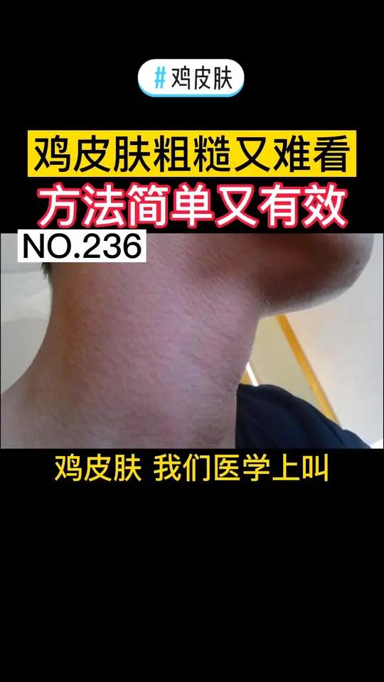 夏季到了,烦人的鸡皮肤怎么改善