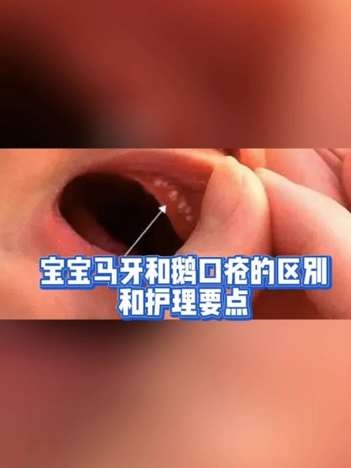 宝宝马牙和鹅口疮的区别和护理要点