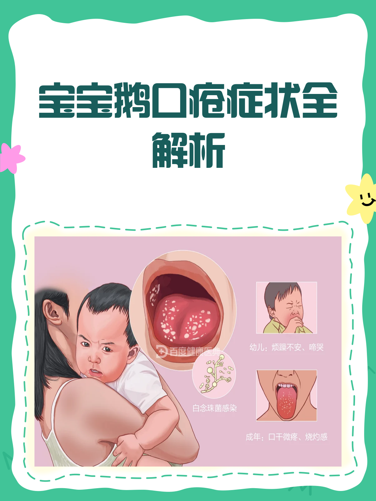 鹅口疮大揭秘!宝宝口腔里的“奶块”是啥?