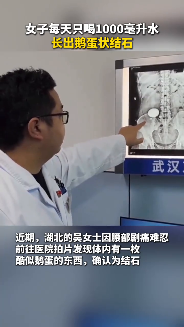 湖北一女子体内长出“鹅蛋”结石!经医生了解,她不太喜欢喝水