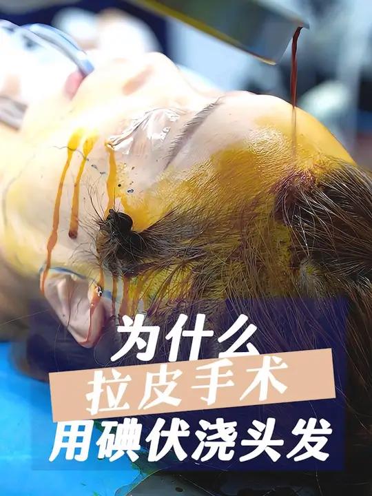 手术开始前用碘伏冲洗头发是为了更好的消毒 因为头皮内有设计的切口,所以要用碘伏来消毒术区
