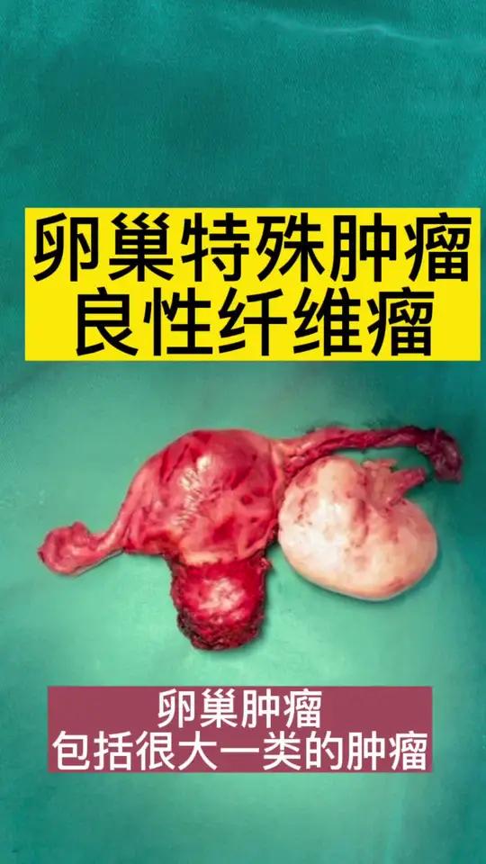 卵巢特殊肿瘤,卵巢性索间质肿瘤。卵巢纤维瘤。卵巢良性肿瘤。医学科普关爱女性健康肿瘤 卵巢