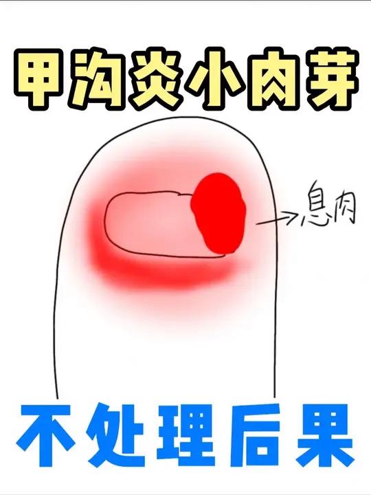 甲沟炎小肉芽如何正确处理？