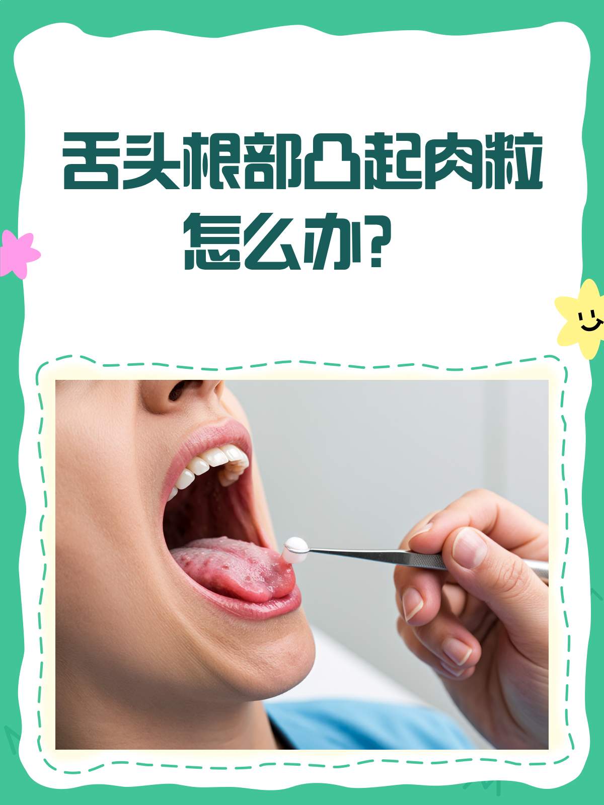 舌头根部的小肉粒,是病还是正常?