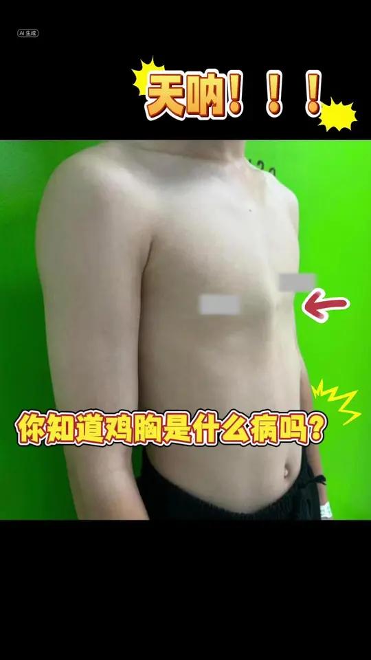 鸡胸是什么 你知道鸡胸是什么病吗医学科普鸡胸儿童胸外科李飞 胸壁畸形