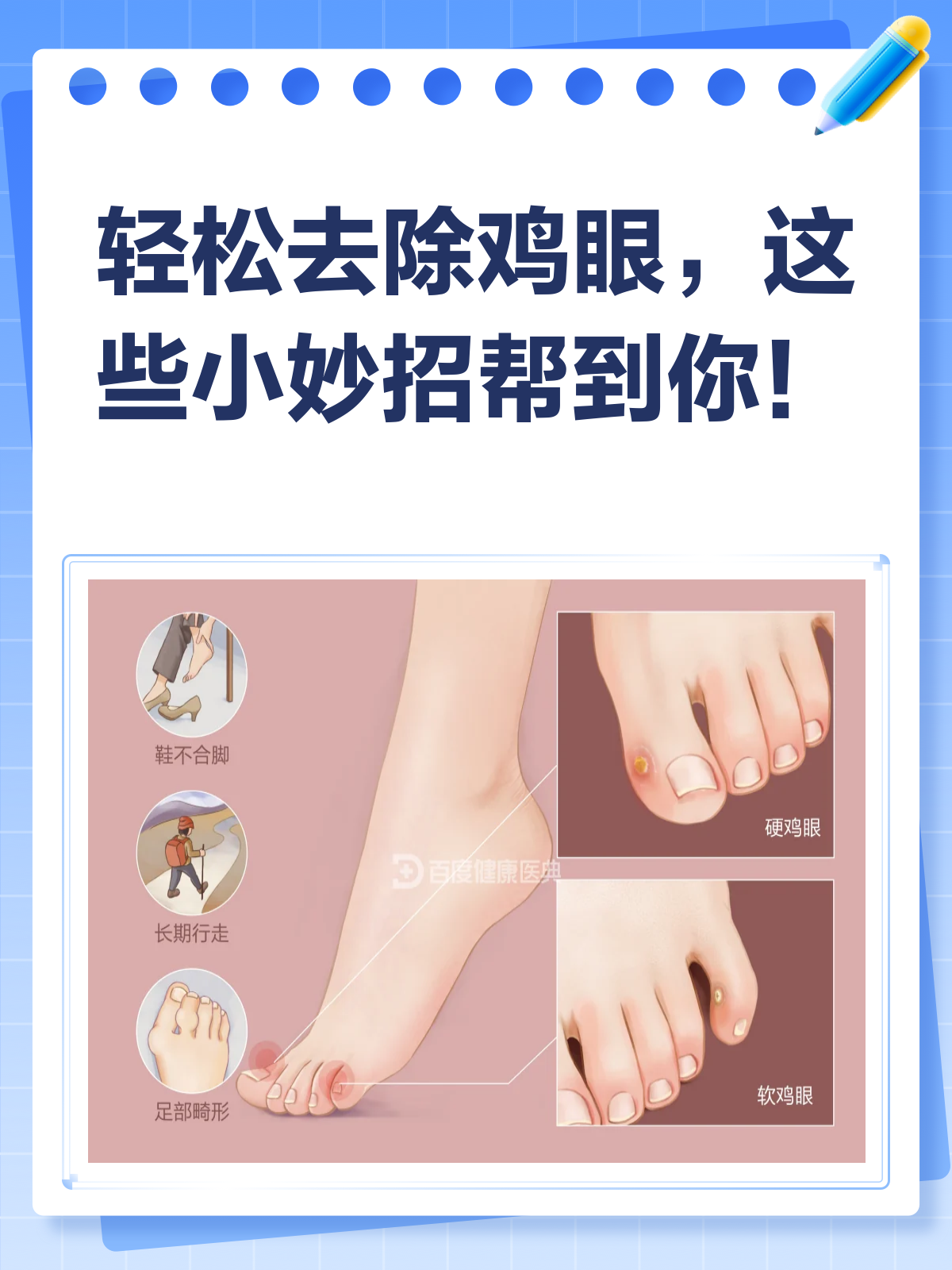 告别疼痛!去除鸡眼的小妙招来啦!