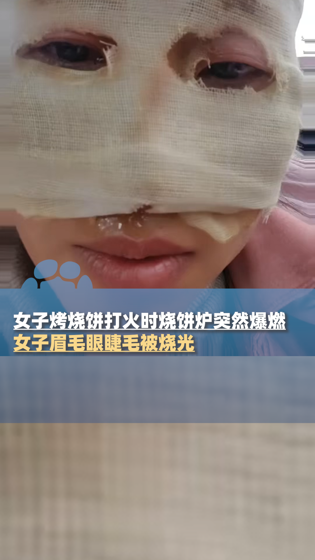 女子烤烧饼打火时烧饼炉突然爆燃,眉毛眼睫毛被烧光