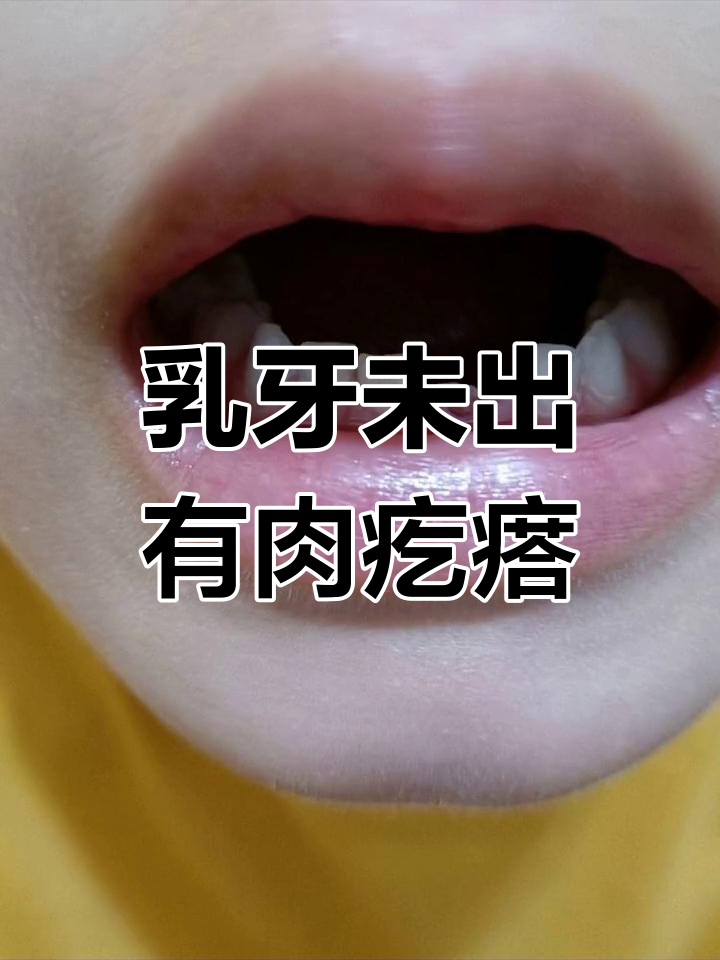 乳牙掉了两天没长出来,牙龈上有个小疙瘩
