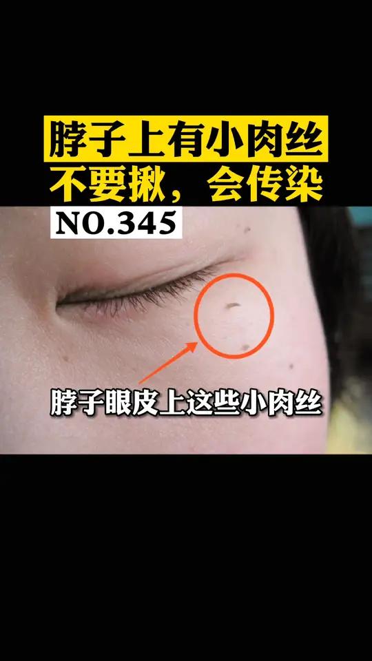 脖子上长了小肉丝或者小肉粒,越来越多,可能是
