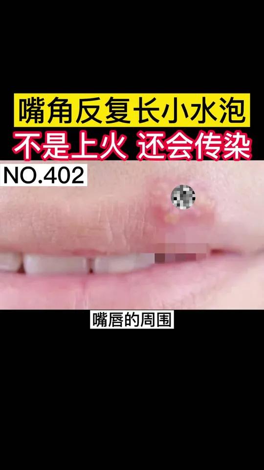 嘴巴嘴角长疱疹,教你怎么快速消除