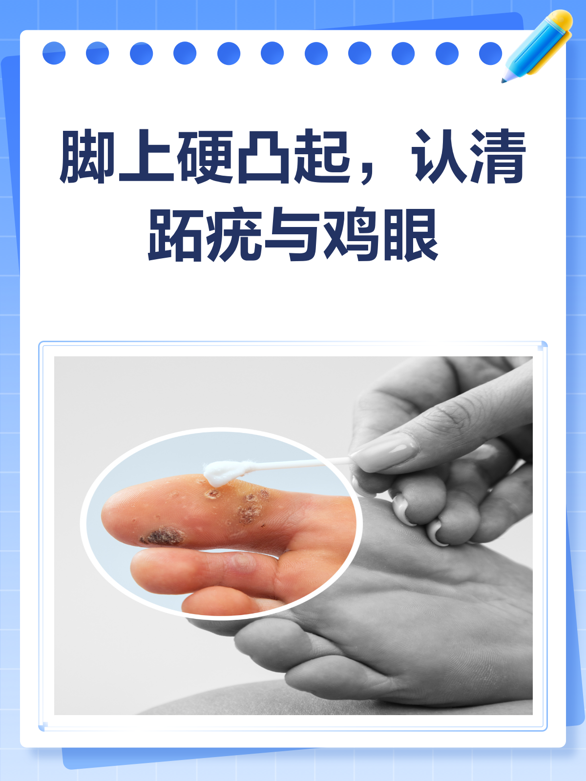 脚上硬凸起?揭秘跖疣、鸡眼的真相!