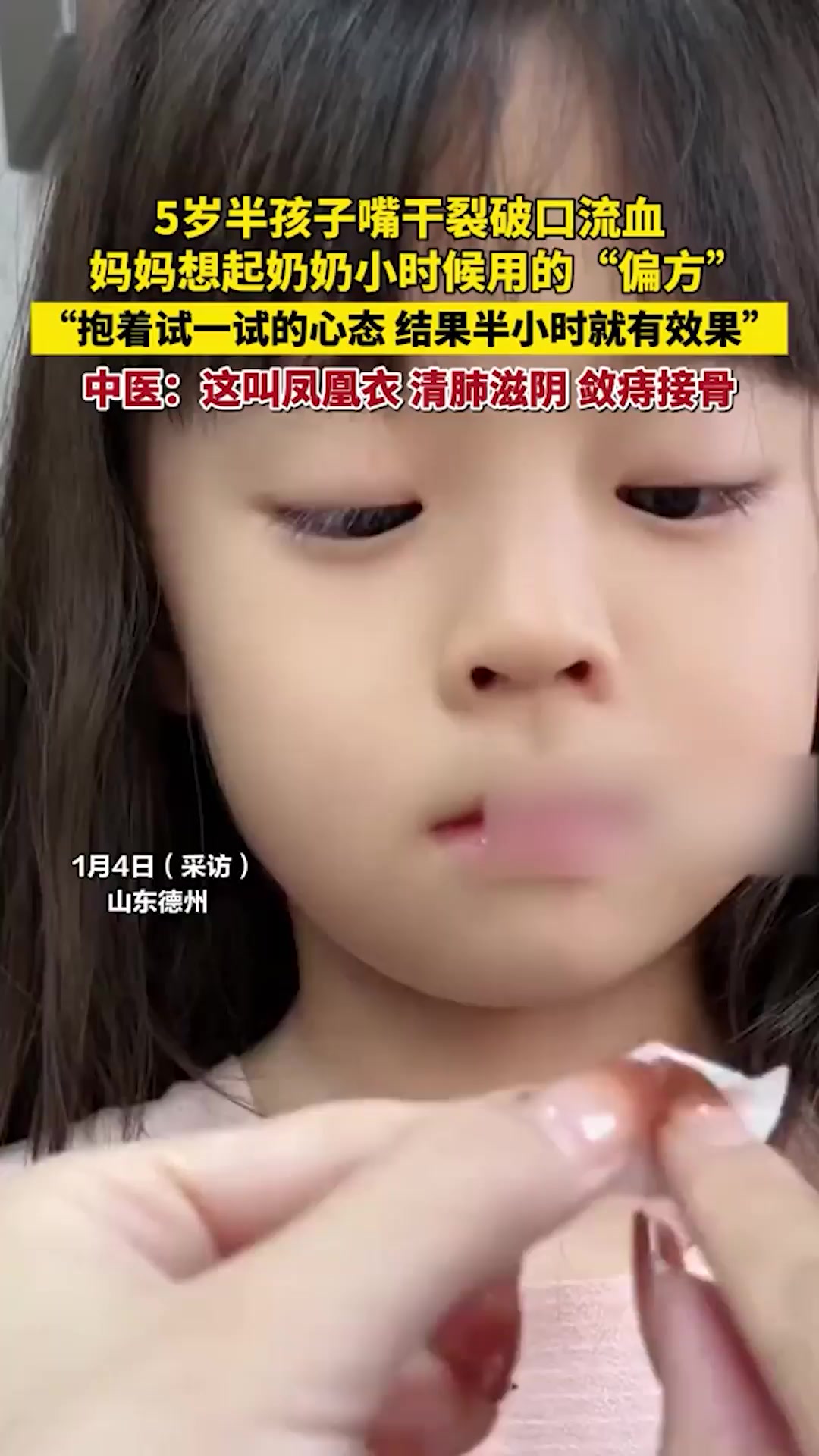 5岁半孩子嘴干裂破口流血,妈妈想起奶奶小时候用的“偏方”:用鸡蛋壳敷嘴