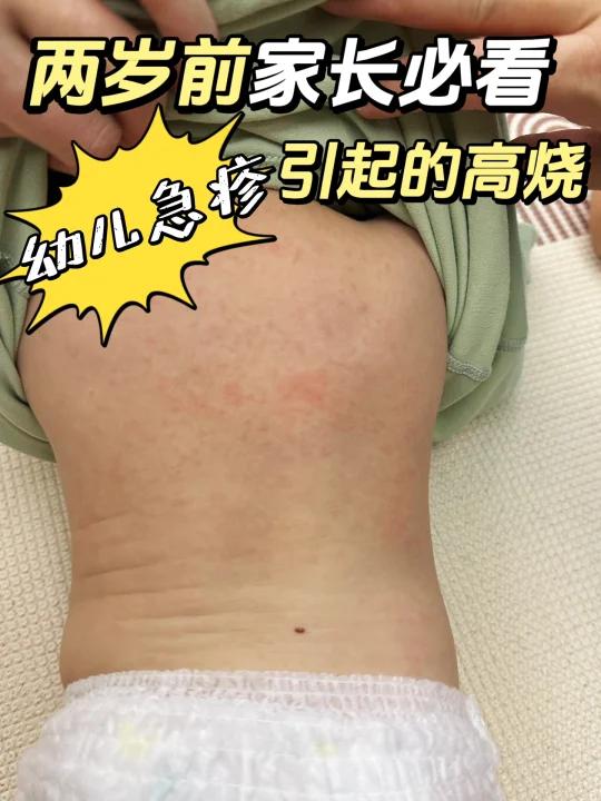 幼儿急疹!对新手妈妈们的碎碎念!必读!
