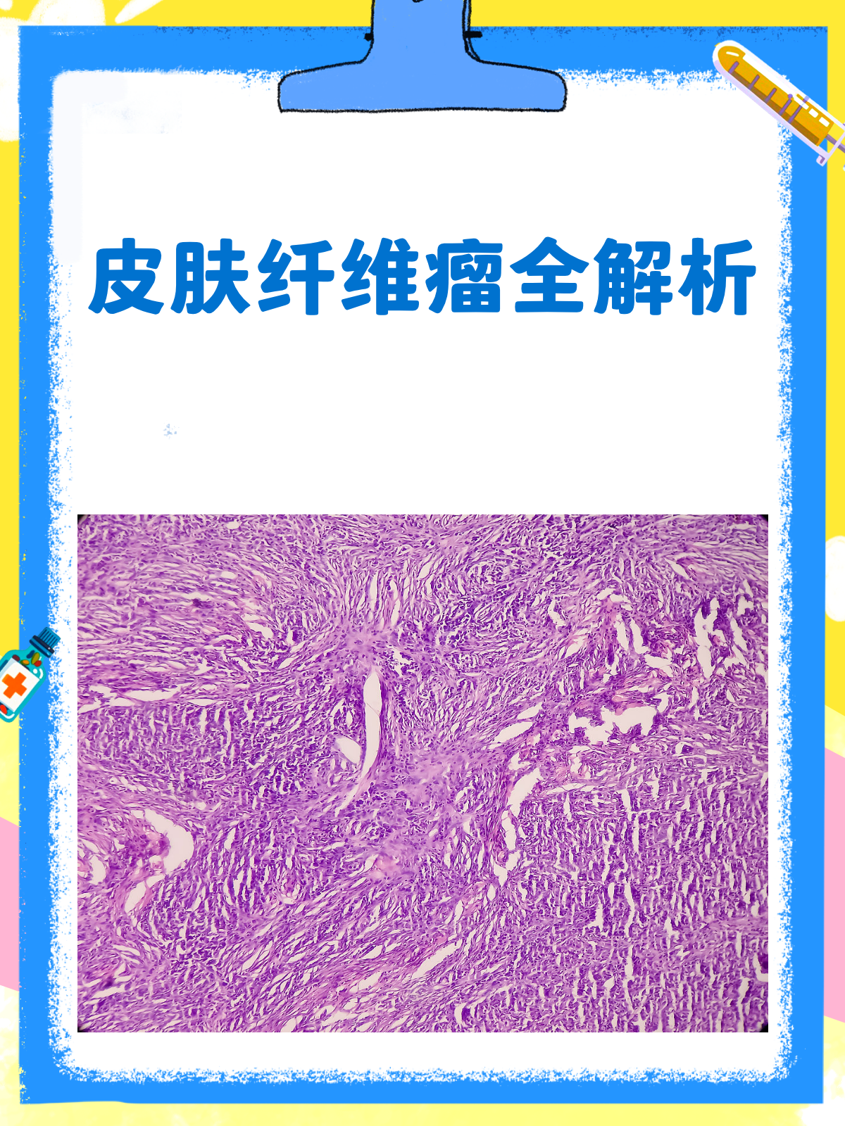皮肤纤维瘤？别怕，一文带你读懂它！