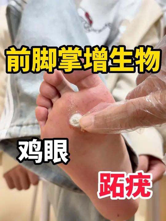 前脚掌增生物 鸡眼还是跖疣