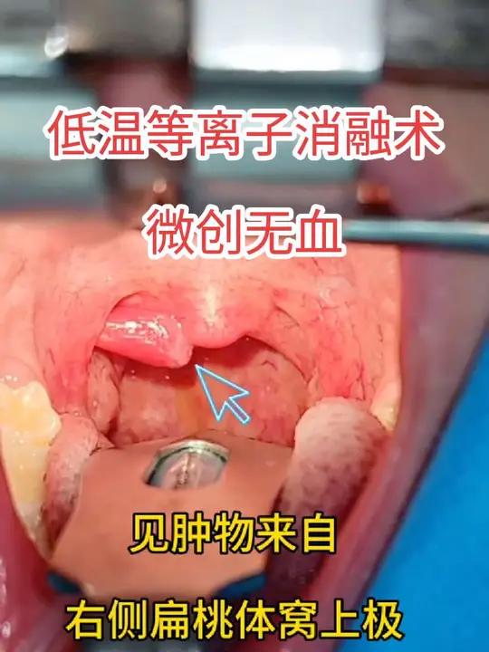 低温等离子消融术,干净不出血 低温等离子消融术,特别适用于增生性肿物,整个过程不见血,手术