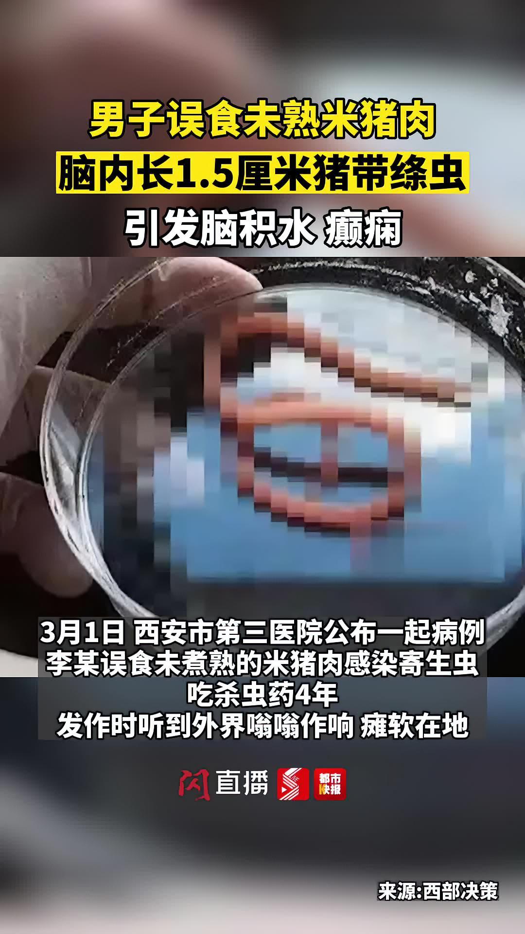 男子误食未熟米猪肉脑内长寄生虫:引发脑积水,猪带绦虫长1.5厘米!西安