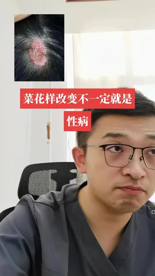 菜花样改变不一定就是性病
