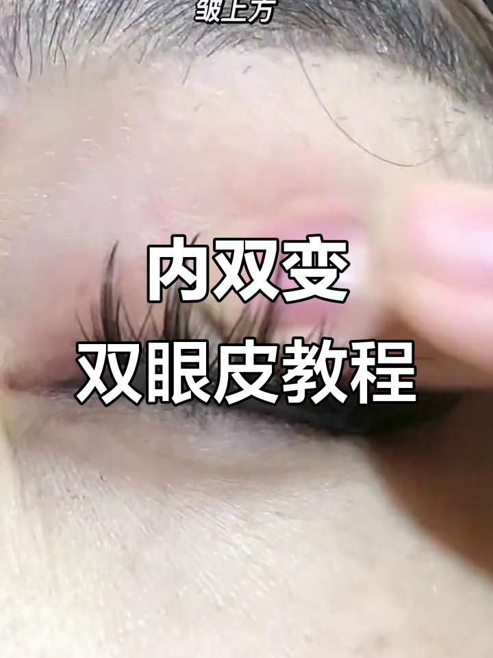 鱼骨轻推法打造平行双眼皮，内双肿眼泡必试技巧
