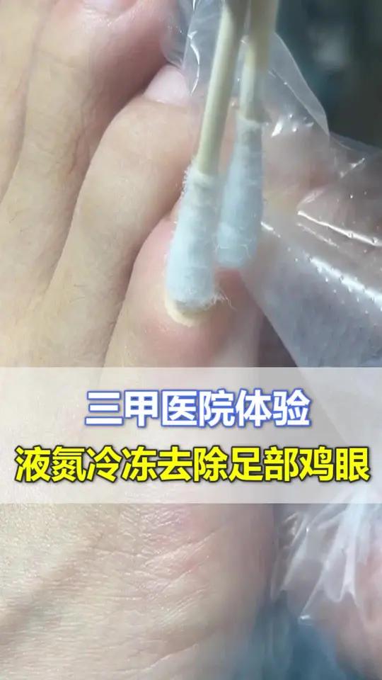 鸡眼可以到医院选择了冷冻处理,但是要避免挤压,否则还会复发噢!