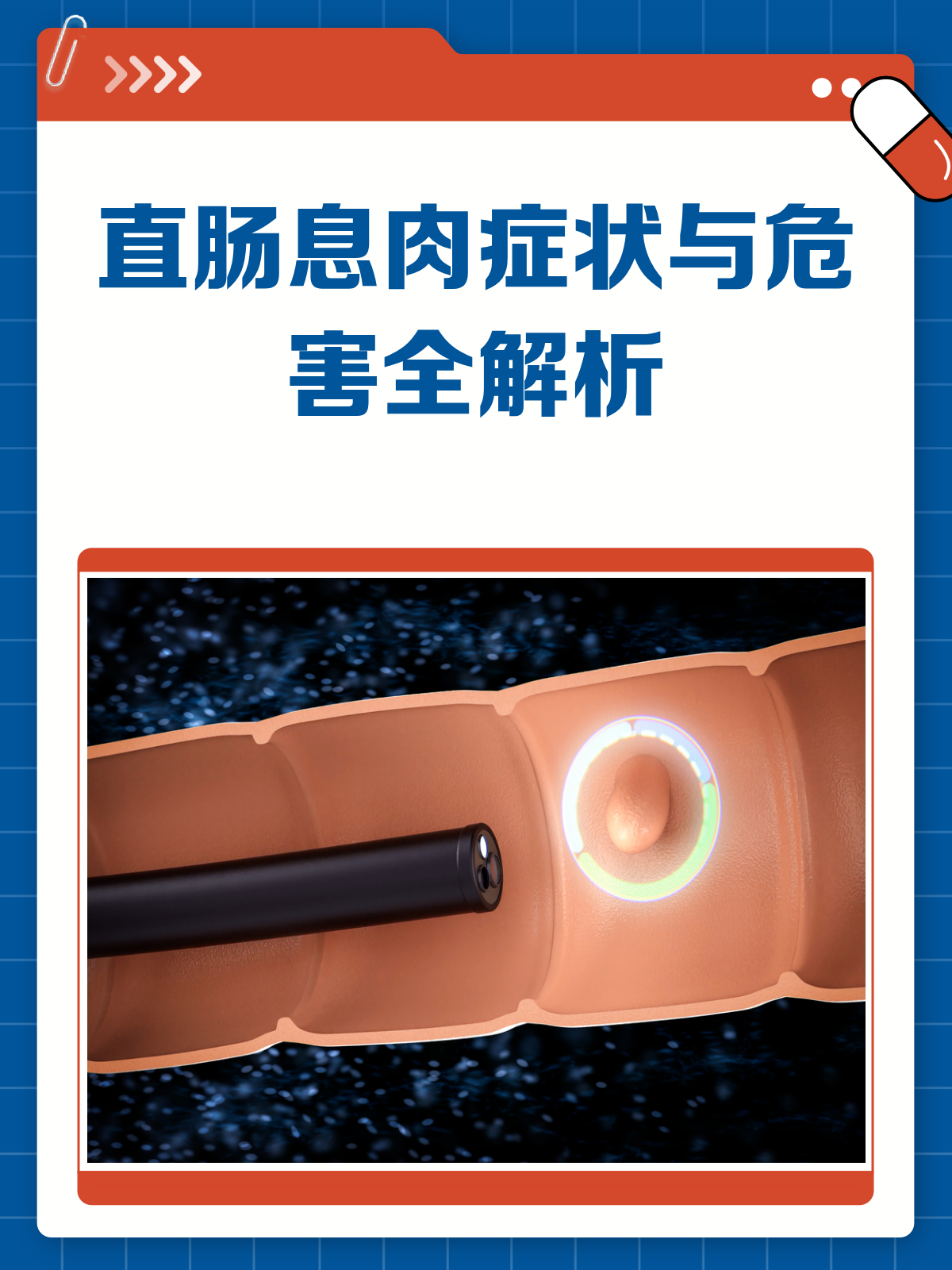 直肠息肉悄无声息？这些症状和危害你得知道！