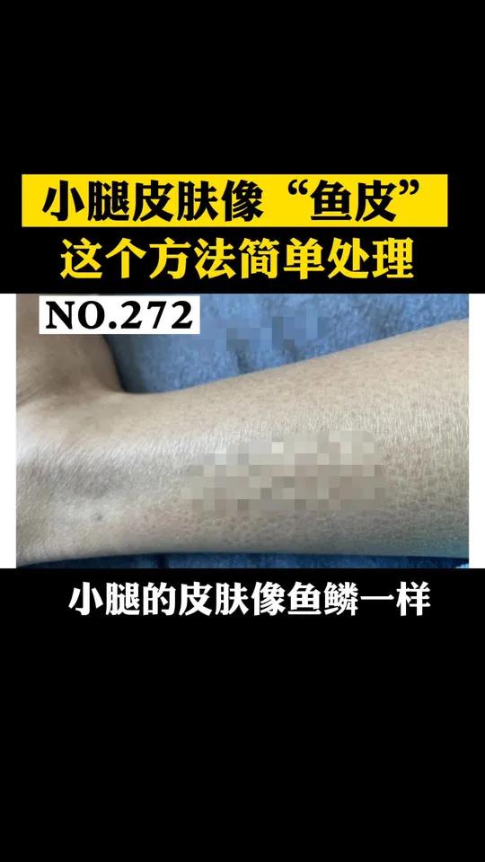 冬季干燥,小腿容易脱屑起皮,皮损长得像鱼鳞一样,这可能是 鱼鳞病,应该怎么处理呢