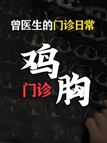 鸡胸分为A、B、C、D型,这名患者小朋友是D型鸡胸,这种情况我们会采用三文治疗法