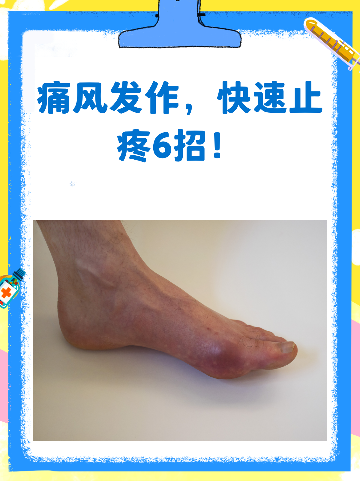 痛风来袭痛不欲生？快速止疼秘籍来啦！