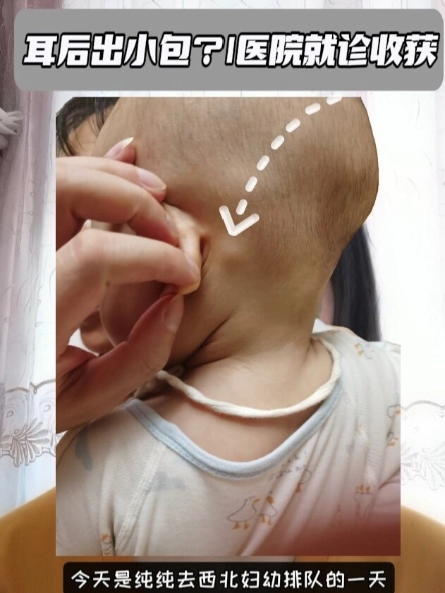 宝宝耳后起疙瘩怎么办?就医分享